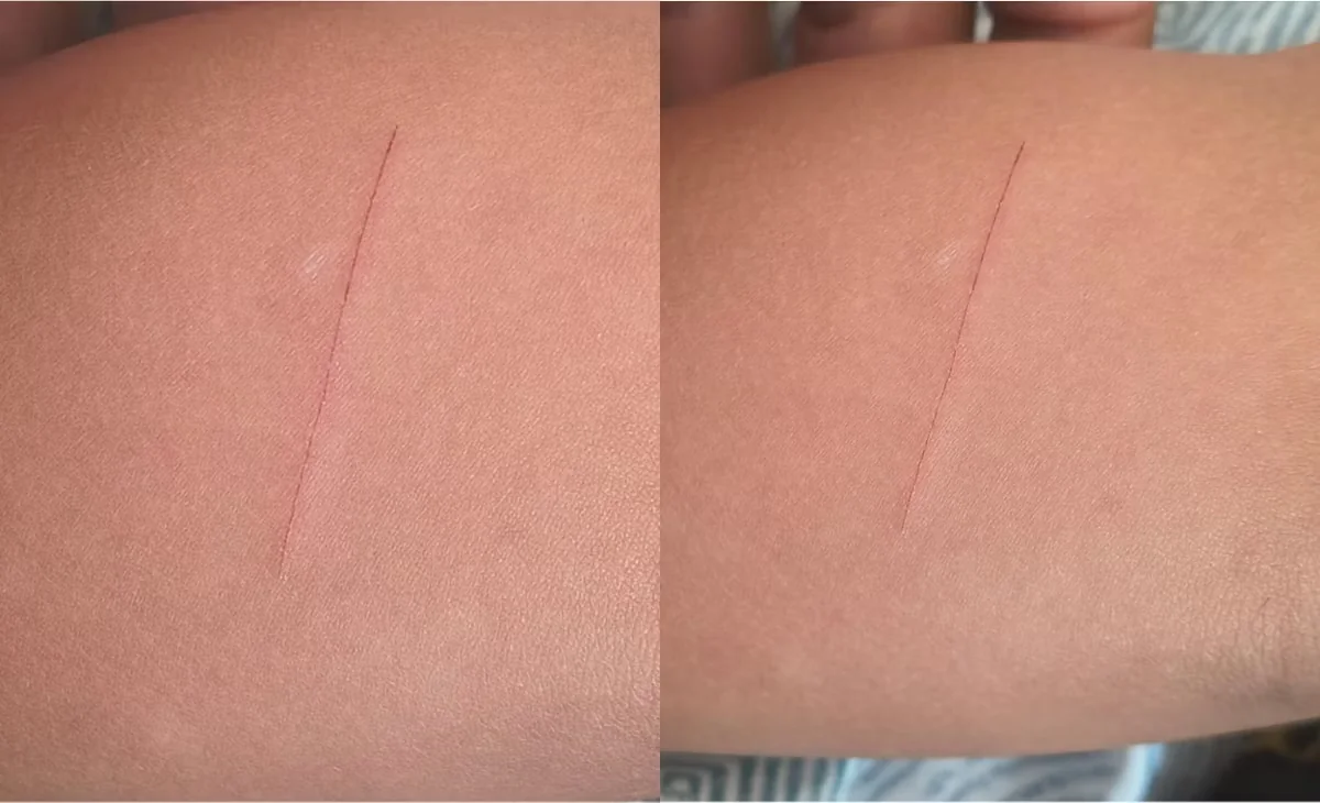 Criança leva navalha para escola e colega de 4 anos fica ferida em Sete Lagoas