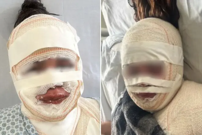 Fisioterapeuta é presa após novas ameaças contra mulher que teria sido atingida com água fervendo
