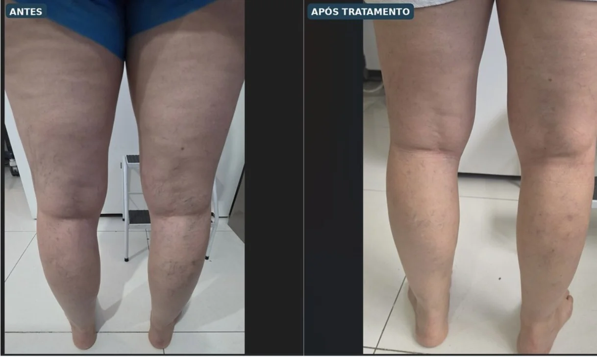 Clínica Cuidar PL explica escleroterapia com espuma para tratamento de varizes