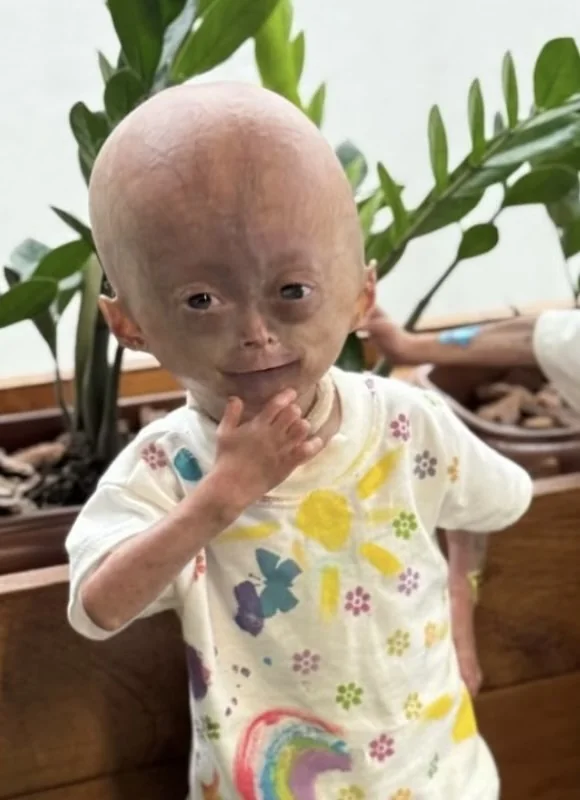 Morre aos 5 anos Elis, uma das gêmeas com síndrome rara de envelhecimento precoce
