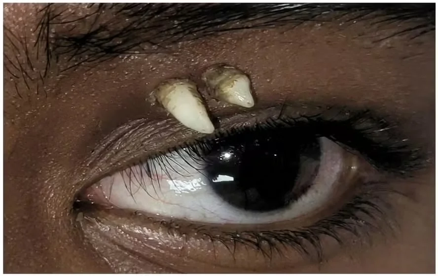 Adolescente de 16 anos passa por cirurgia após dente nascer entre o olho e a sobrancelha