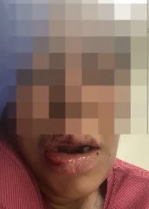 Homem é suspeito de arrancar dentes da ex-namorada com alicate durante agressão em MG